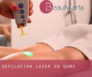 Depilación laser en Gums